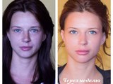 Коррекция скул гиалуроновой кислотой до и после Коррекция скул гиалуроновой кислотой до и после
