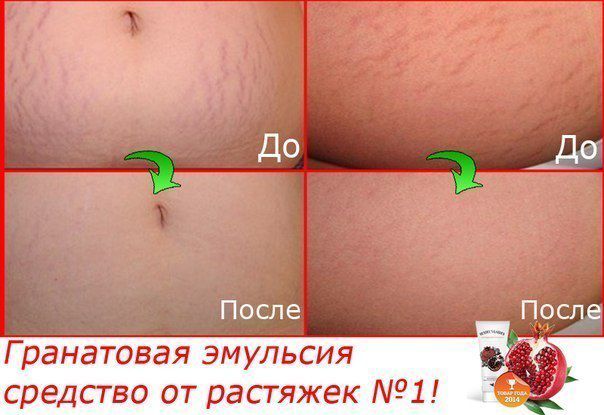 Как можно убрать растяжки в домашних условиях
