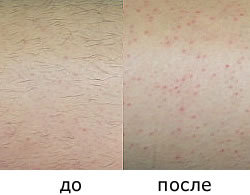 Через сколько проходит раздражение после эпиляции Через сколько проходит раздражение после эпиляции