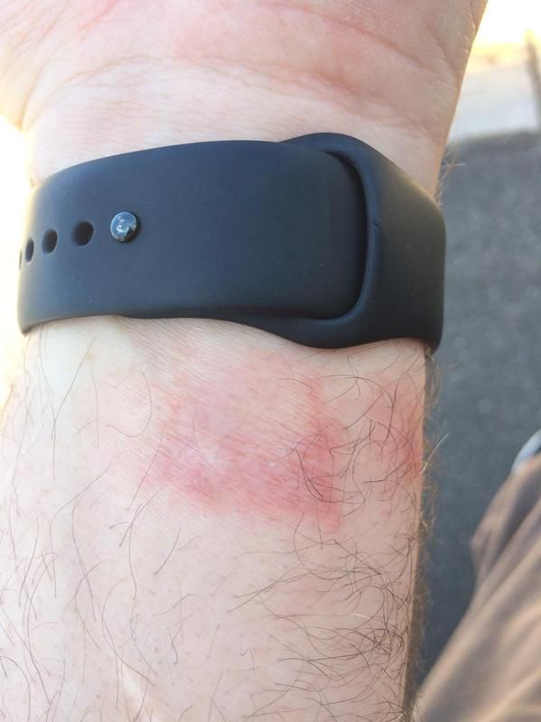 Жительница Канады обожгла руку часами Apple Watch