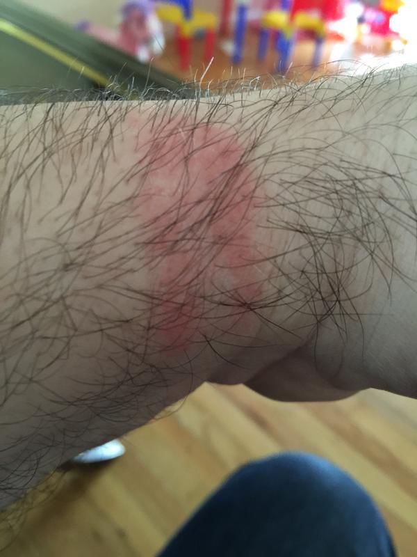 Жительница Канады обожгла руку часами Apple Watch