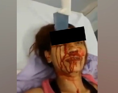 Бразильянка выжила после удара в голову кухонным ножом