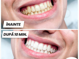 отбеливающие полоски для зубов - MySmile foto 6