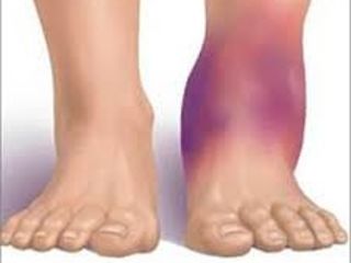 Simptomele si tratamentul artrozei gleznei si a labei piciorului