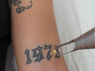 Laser tattoo Chişinău Лазер тату Кишинев