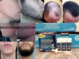 Оригинальный Minoxidil - революционное средство для роста волос и бороды! foto 6