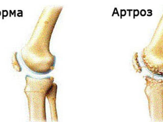 Magnetoterapie pentru durerea articulației genunchiului - Artroza genunchiului