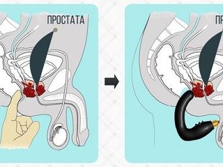 prostatita cu apa argintie