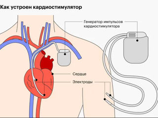 Как выбрать кардиостимулятор и как жить без боли