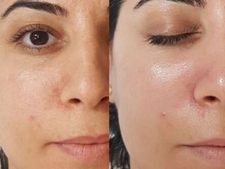 Cosmetolog BioRePeel + curățare facială foto 3