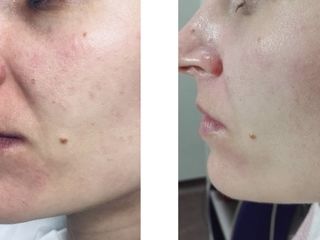 Cosmetolog BioRePeel + curățare facială foto 6