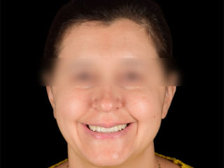  Implant dentar la pret adecvat.  foto 3