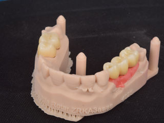  Implant dentar la pret adecvat.  foto 0