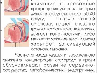 Лечение храпа и обструктивного апноэ сна. Tratamentul sforaitului si apneei de Somn Cpap sipap apap foto 4