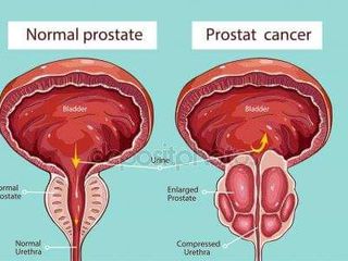 azitromicina prostatitis crónica prostatita cauze de exacerbare