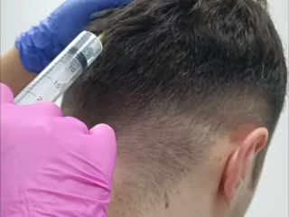 Ozonoterapie pentru păr ( în alopecie)