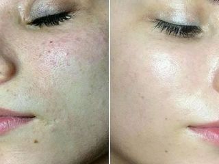 Cosmetolog BioRePeel + curățare facială foto 2