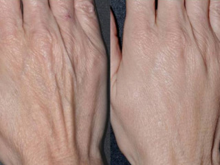 Парафинотерапия рук / Гладкие руки