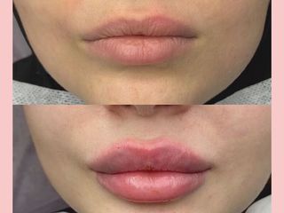 Mărirea buzelor cu acid hyaluronic foto 10