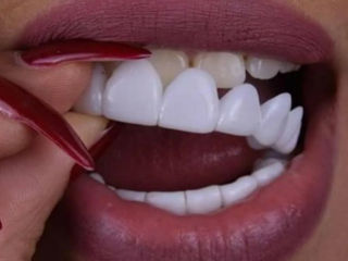 Съемные виниры для зубов Snap-On Smile. Подарите себе идеальную улыбку