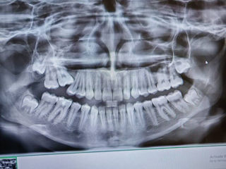 Echipament Radiologie Dentara foto 6