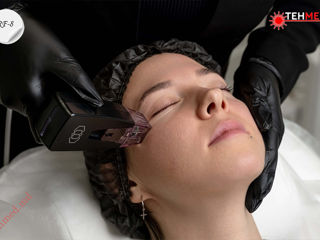 Фракционный микроигольчатый RF лифтинг  Microneedling fracționat Morpheus RF-8 foto 8