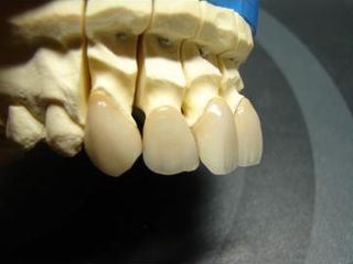 laborator dentar cad cam,dinti din zirconiu,venire, inlay, onlay foto 1