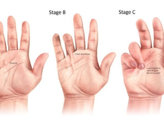 Tratăm contractura(sindromul) Dupuytren Лечим контрактуру(синдром) Дюпюитрена foto 2