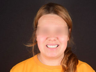  Implant dentar la pret adecvat.  foto 0