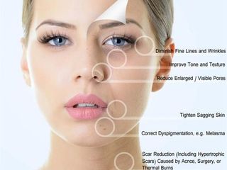 Mezoterapie fracționată/ Microneedling/ Dermapen foto 6