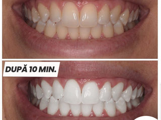 отбеливающие полоски для зубов - MySmile foto 4