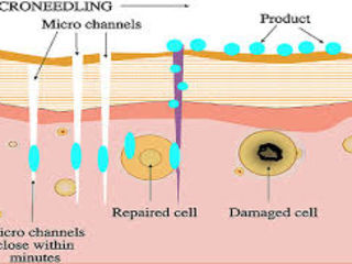 Mezoterapie fracționată/ Microneedling/ Dermapen foto 4