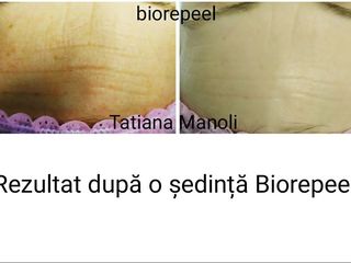 BioRePeelCl3-procedura cu rezultate imediate.Buiucani foto 6