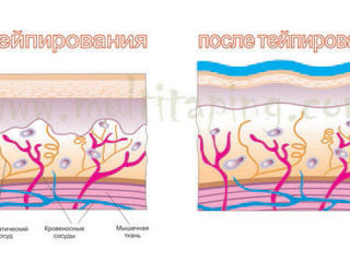 От 80 лей. Kinesio tape(Banda kinesiologica). Спорт, реабилитация, косметология. foto 3