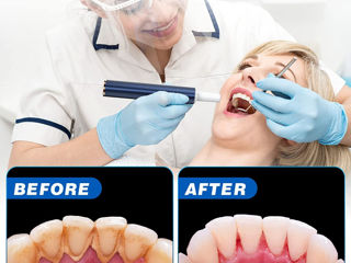 наборы для чистки зубов pentru indepartarea pietrei dentare foto 4