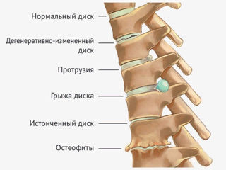 Сorector ortopedic pentru coloana vertebrală foto 8