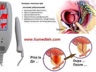Аппарат для лечения простатита (не Китай) foto 4