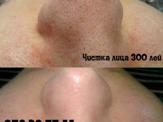 Чистка лица ультразвуковая( Curatarea fetei cu ultrasunet) на Anna Lotan всего 300 лей foto 3