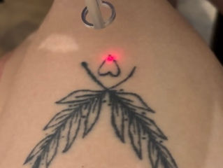 Удаление тату лазером, Ștergerea tattoo cu laser foto 2