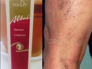 ajuta la tratamentul varicozei cremă care zboară de la varicoză