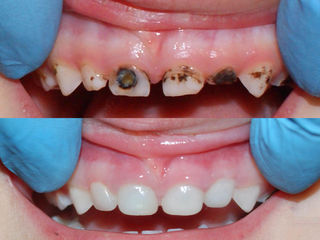 Детская стоматология, без общего наркоза.