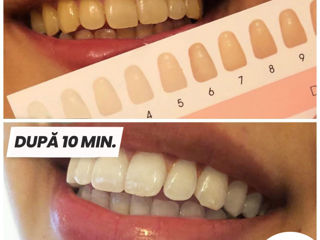 отбеливающие полоски для зубов - MySmile foto 9