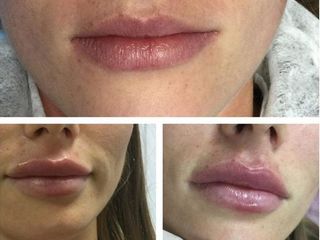 Гиалуроновая кислота, мезотерапия, пилинг, липолиз, botox,Увеличение губ ,marirea buzelor foto 3