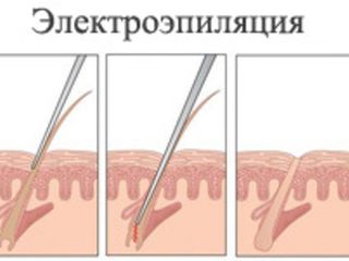 Электроэпиляция! Чеканы! foto 5