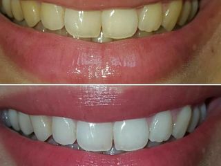 Профессиональное отбеливание зубов в домашних условиях от White Light! foto 4