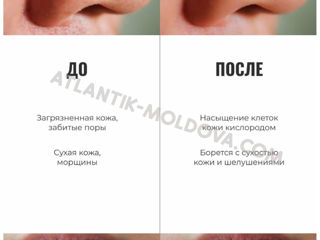 Profesionalul aparat cu ultrasunete pentru curățarea feței.Livrare gratuită în Moldova foto 15