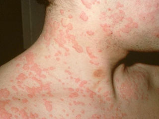 Tratăm urticaria Лечим крапивницу foto 2