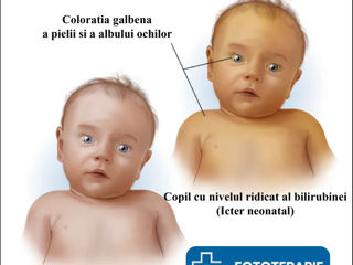 Chiria/Livrarea lămpilor pentru fototerapie - Icter bebelusi / лечение от желтухи foto 4