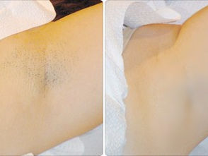 Epilator IPL,Rejuvenare,Curatare acnee, Alb Фотоэпилятор IPL foto 13