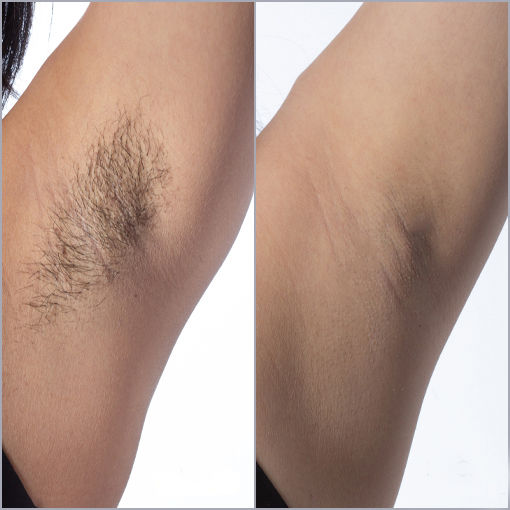Epilare cu laser în Chișinău fără durere! Cu laser german de înaltă calitate. foto 4
